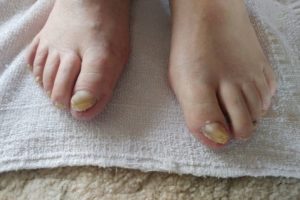 Medical Pedicures | Boise, Idaho