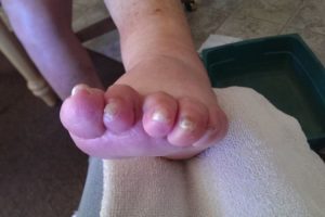 Medical Pedicures | Boise, Idaho