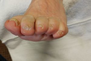 Medical Pedicures | Boise, Idaho