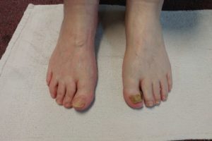 Medical Pedicures | Boise, Idaho