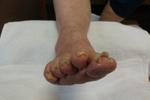 Medical Pedicures | Boise, Idaho