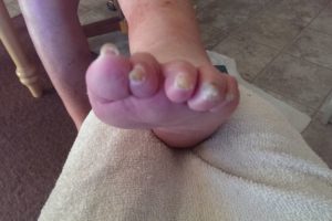 Medical Pedicures | Boise, Idaho