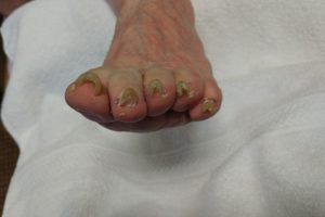 Medical Pedicures | Boise, Idaho