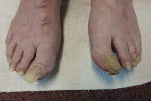 Medical Pedicures | Boise, Idaho