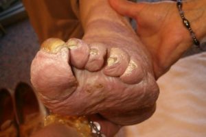 Medical Pedicures | Boise, Idaho